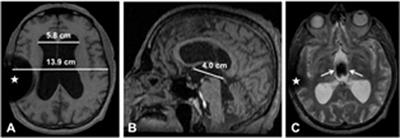 Deep Brain Stimulation Surgery for Parkinson Disease Coexisting With Communicating Hydrocephalus: A Case Report